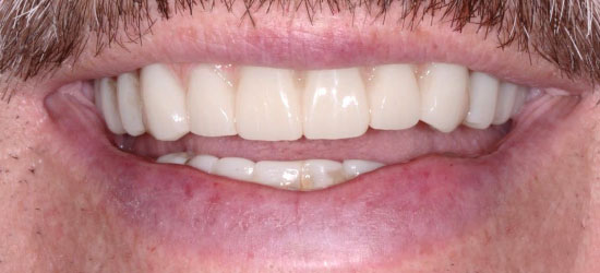After dental treatment image3