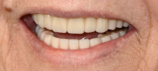 After dental treatment image2