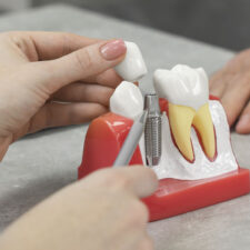 Things you may not know about All On 4 Dental Implants