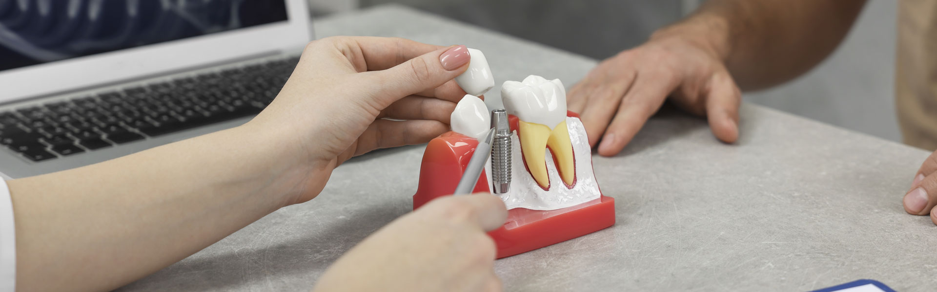 Things you may not know about All On 4 Dental Implants